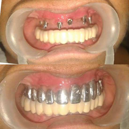 Tooth Colour Filling
